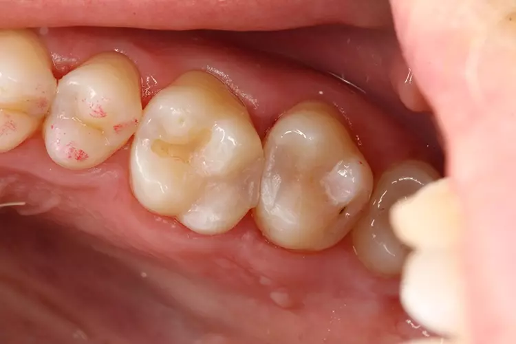 Abb. 10: Nach Ausarbeitung, Politur und Funktionsprüfung der Restaurationen an den Zähnen 26 und 27 wird der Patient entlassen.
