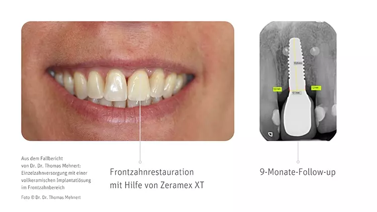 Mit der Zeramex Demobox können chirurgisch und prothetisch tätige Zahnärzt:innen das Implantatsystem Zeramex XT Hands-On kennenlernen.