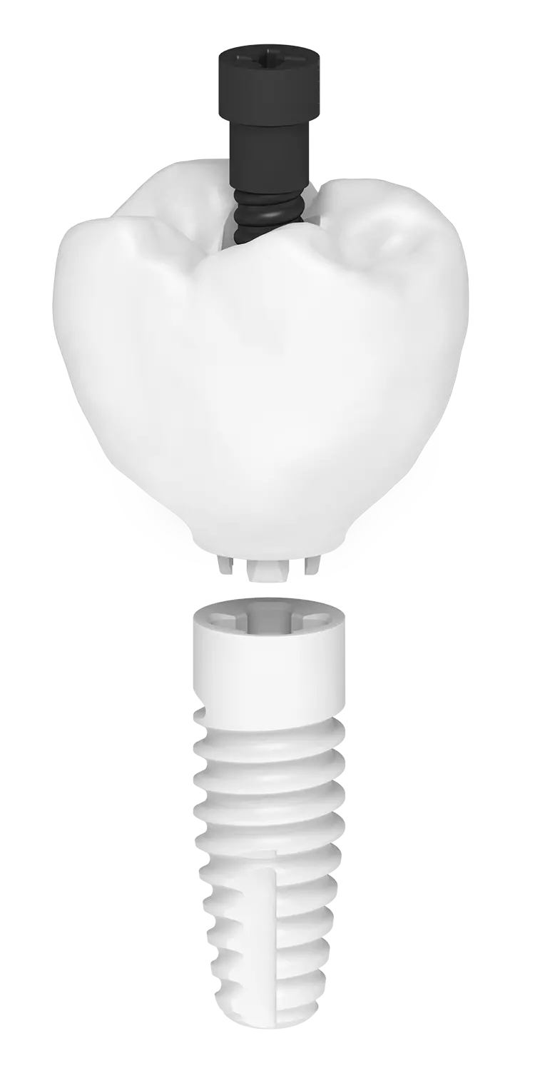Zeramex XT – das zweiteilige, metallfreie und reversibel verschraubte Keramikimplantatsystem mit der carbonfaserverstärkten Vicarbo® Schraube.