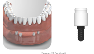 Zeramex XT Docklocs® ist ein vorgefertigtes Verbindungssystem zum Befestigen von herausnehmbarem Zahnersatz auf der Basis einer Schnappverbindung. Docklocs® Abutments sind in drei Grössen (2 mm / 3 mm / 4 mm) verfügbar und passen auf alle Implantatpla