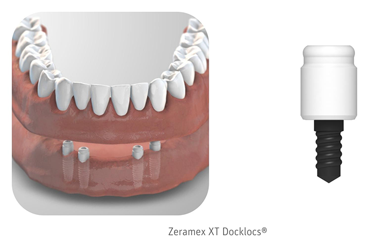 Zeramex XT Docklocs® ist ein vorgefertigtes Verbindungssystem zum Befestigen von herausnehmbarem Zahnersatz auf der Basis einer Schnappverbindung. Docklocs® Abutments sind in drei Grössen (2 mm / 3 mm / 4 mm) verfügbar und passen auf alle Implantatpla