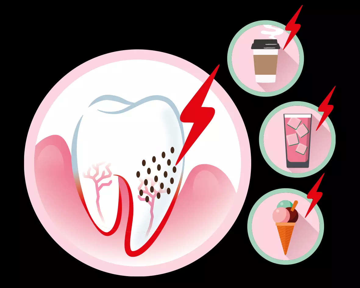 Dentinüberempfindlichkeit trifft rund 42% der erwachsenen Bevölkerung.