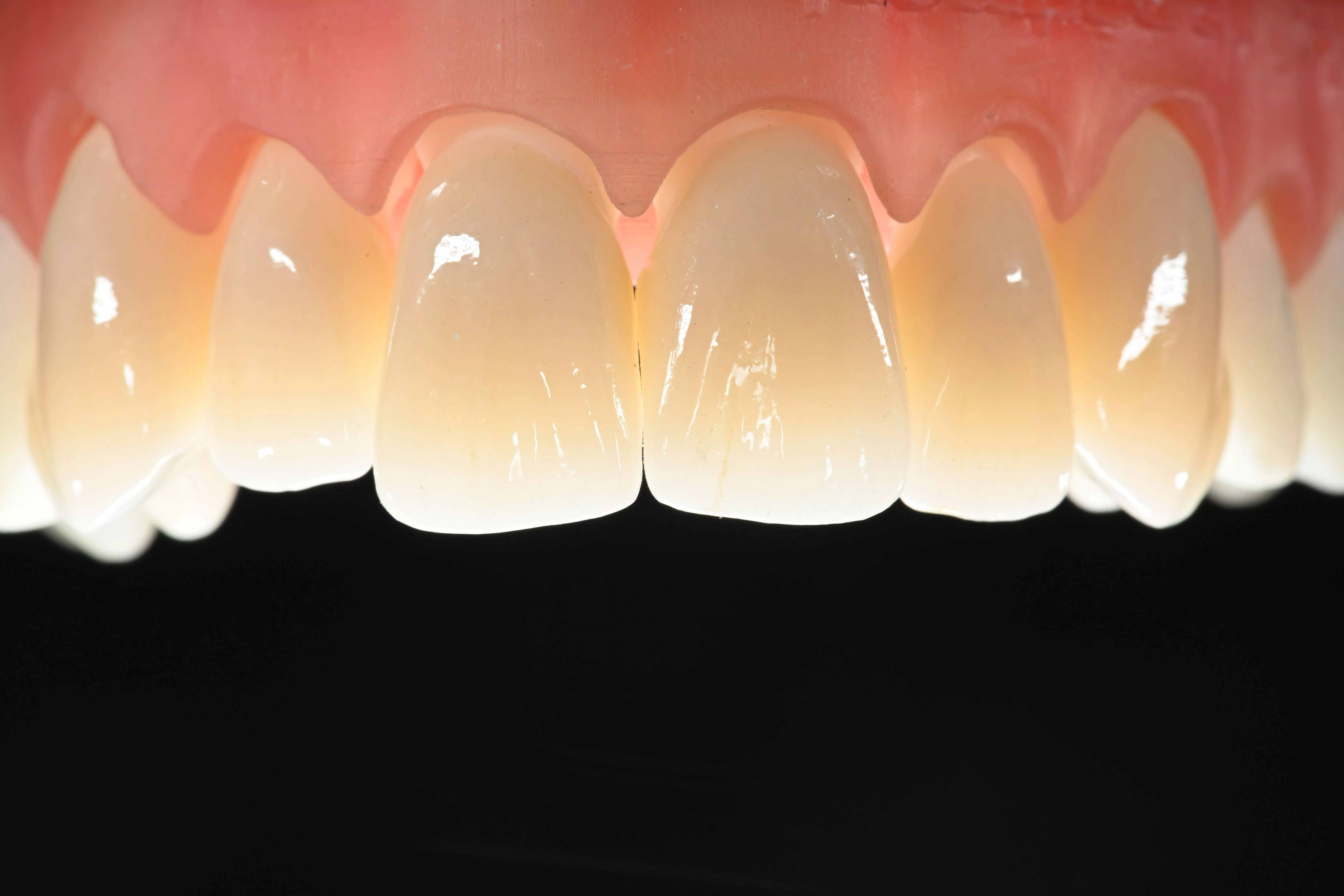 optimill 3D Pro Zir beeindruckt u. a. mit seiner hohen Transluzenz und erlaubt Dank der hohen Festigkeit zugleich den Einsatz für alle Indikationen.