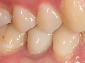Nachher: Transluzente Zirkonoxid-Krone mit individualisiertem Finishing.