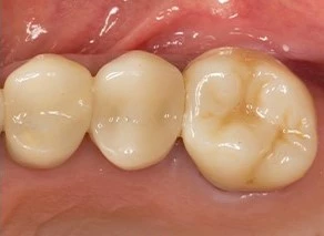 Nachher: Transluzente Zirkonoxid-Vollkrone für ein ästhetisches Resultat mit maximaler Widerstands- und Retentionsform.