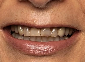 Vorher: Insuffiziente Füllungen an den Zähnen 12 bis 22, eine ungleichmäßige Gingivalinie an 12 bis 11 und stark erodierte Schneidekanten.