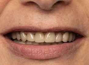 Nachher: Vier ästhetisch hochwertige und individualisierte Lithium-Disilikat-Keramikkronen.