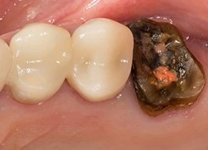 Vorher: Frakturierte Metallkeramikkrone an Zahn 14, der früher endodontisch behandelt worden war.
