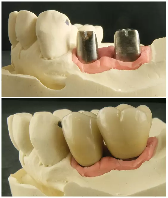 Abb. 2 u. 3: Digitale Erfahrung hatte ich schon lange: mit individuell konstruierten und extern gefrästen CAD/CAM-Abutments (Atlantis/Dentsply Sirona). Die restliche Herstellung erfolgte dann gemischt analog/digital.