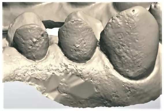 Abb. 11: Oberflächenungenauigkeiten durch unsachgemäßen Puderauftrag.