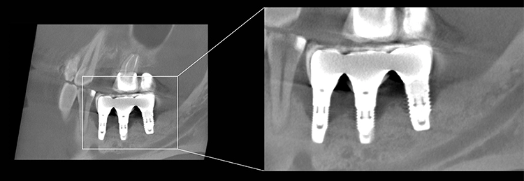 Aufnahme zur Klärung der Anatomie: Expositionsparameter: 100 kV – 5 mA – 9,4 s – 560 mGycm2, FOV: 10 x 8 cm.