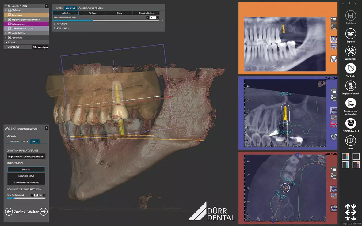 Intuitive und effiziente Implantatplanung mit VistaSoft Implant.