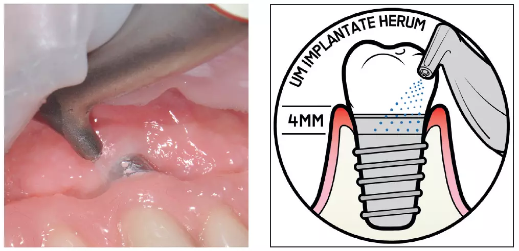 Abb. 5a u. b: Auch für die Reinigung von Implantatoberflächen und Suprastrukturen kann Airflow oder Perioflow eingesetzt werden, wiederum mit entsprechend schonenden Pulvern.