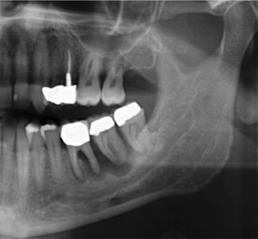 Abb. 2a): Ausgangsbefund: Knochendefekt um 36 und 37.