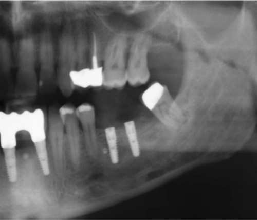 Abb. 2f): Kontrolle nach Implantation mit Schablone.