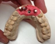 Abb. 3: 3D-Fehlplanung, bei der die Implantate einzeln geplant wurden.
