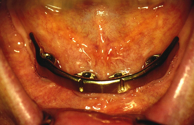 Abb. 4: Implantatpositionierung ohne prothetische Planung. Die Implantate stehen zu weit lingual. Konzeptänderung oder Neuimplantation.