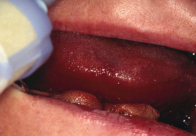 Abb. 7: Linguale Perforation bei Implantation in der frontalen Unterkieferregion. Starke Zungenschwellung, Mundbodenkompressionsnaht und Intubation.