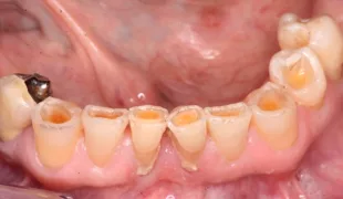 Erosive und abrasive Defekte im Zahnhals- und Inzisalbereich der Unterkieferfrontzähne bei einem 76-jährigen Patienten.