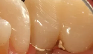 Eine insuffiziente Interimsversorgung kann eine Periimplantitis zur Folge haben.