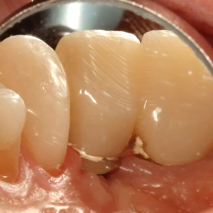 Eine insuffiziente Interimsversorgung kann eine Periimplantitis zur Folge haben.