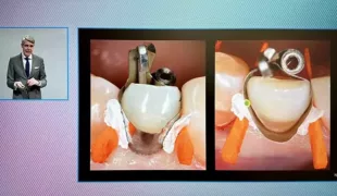 Der Online-Kongress liefert eindrucksvolles Bildmaterial, hier ein Bildschirmausschnitt (Handyfoto) aus dem Vortrag von Prof. Dr. Thomas Attin.