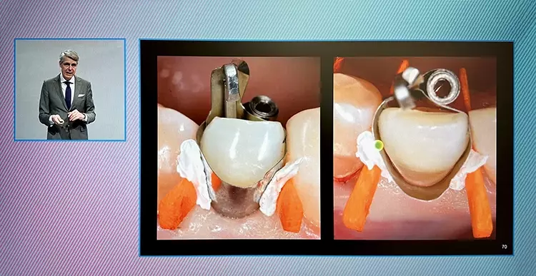 Der Online-Kongress liefert eindrucksvolles Bildmaterial, hier ein Bildschirmausschnitt (Handyfoto) aus dem Vortrag von Prof. Dr. Thomas Attin.