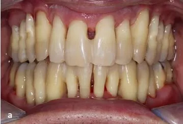 Abb. 2a: Klinische Situation mit multiplen freiliegenden Wurzeloberflächen nach Abschluss der aktiven Therapie. a: Frontalansicht, ...