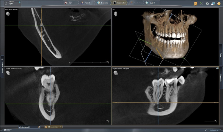 Endo-Layout des neuen Sidexis 4 V 4.3.