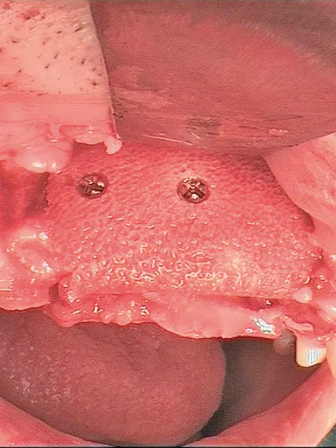 Abb. 19: Der Knochenblock in situ.