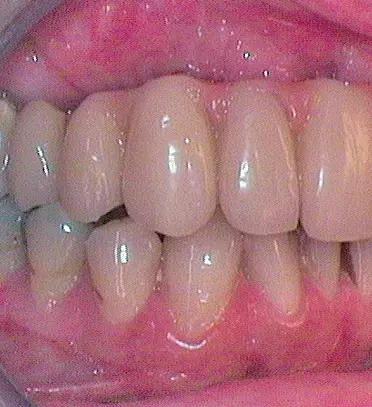 Abb. 23: Klinische Ansicht post Knochenblocktransplantation.