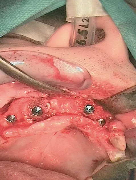 Abb. 26: Vier definitive Implantate in situ.