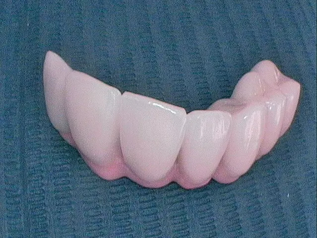 Abb. 35 a und b: Transversal verschraubte Implantatversorgung.