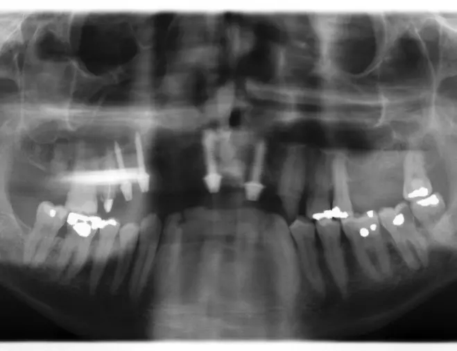 Abb. 7: Postoperatives OPG mit Interimsimplantaten.