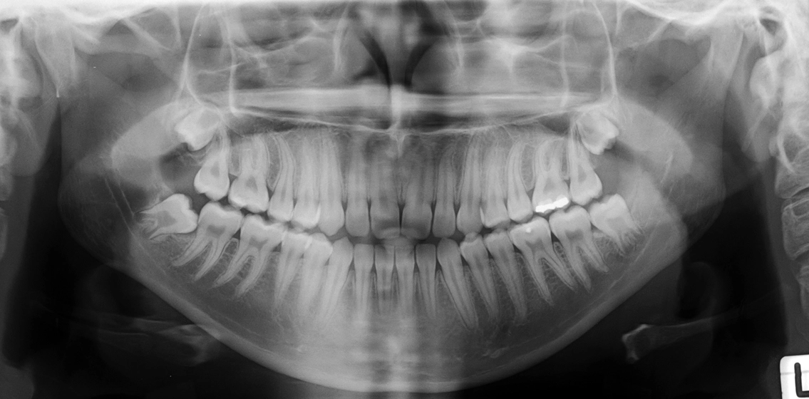 Abb. 11b: Orthopantomogramm.