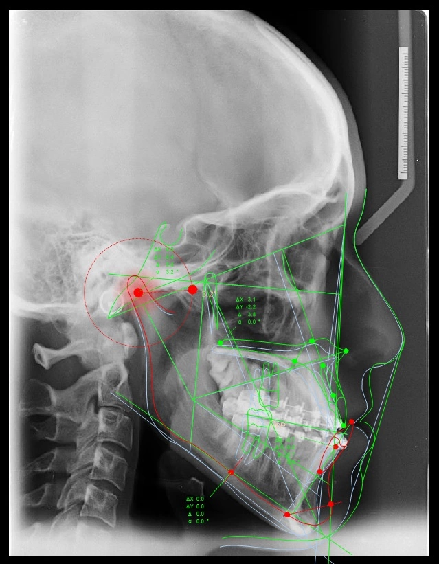 Abb. 12: Simulation der chirurgischen Impaktion der Maxilla und der folgenden Reaktion der Mandibula mit den Kondylen als „Rotationszentrum“ im Sinne einer Autorotation nach kranial und gleichzeitig nach ventral.