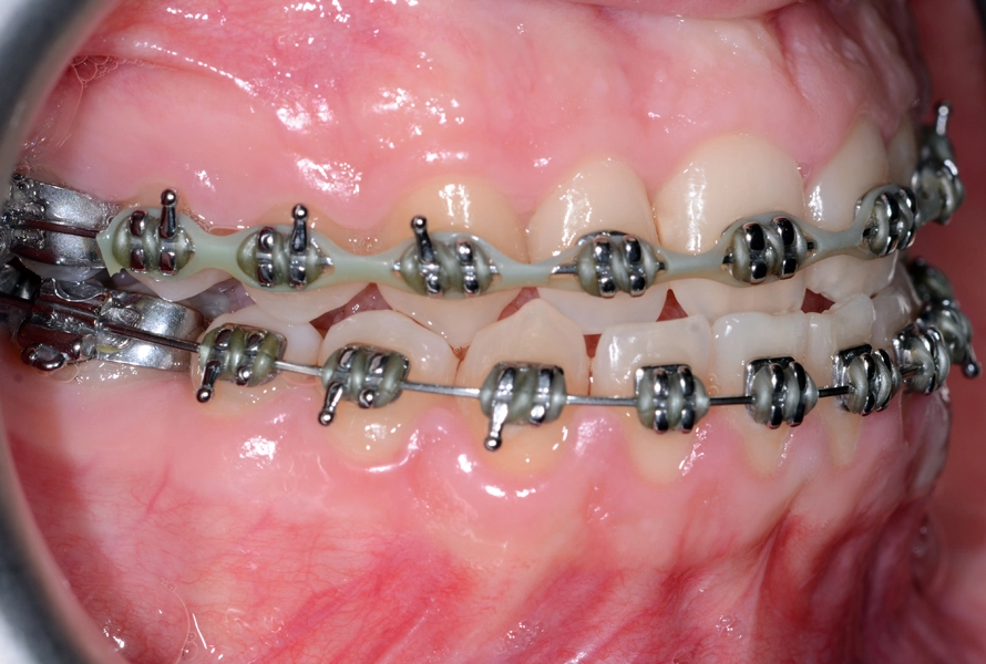 Abb. 13a–e: Intraorale Aufnahmen nach der Abstimmung der dentoalveolären auf die skelettale Dysgnathie.