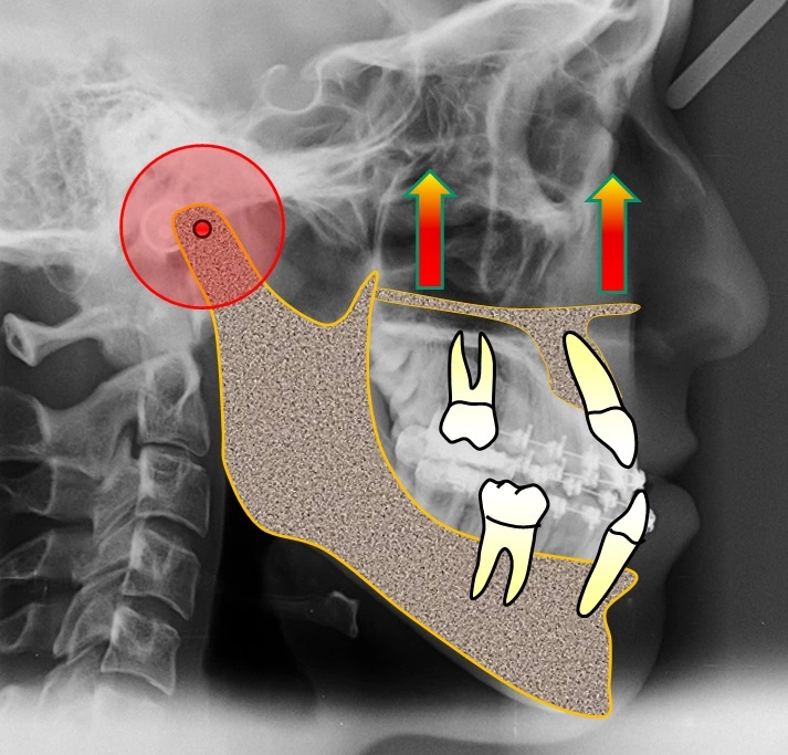 Abb. 14a–g: Chirurgische Planungsschritte.
a: Chirurgische Impaktion mit Vorverlagerung der Maxilla.