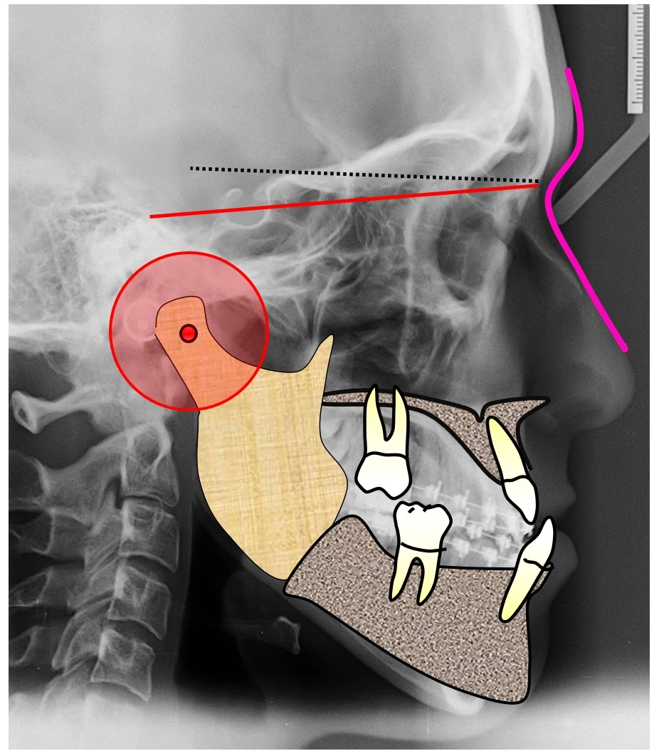 Abb. 14a–g: Chirurgische Planungsschritte.
b: Reaktion der Mandibula im Sinne einer Autorotation nach kranial und gleichzeitig nach ventral – Folge war die tatsächliche Position der Mandibula in der Vertikalen und der Sagittalen.