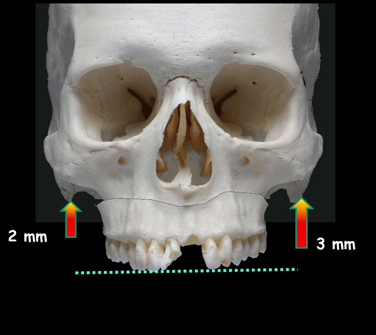 Abb. 14a–g: Chirurgische Planungsschritte.
f: Eine größere Impaktion auf der linken Seite für die Korrektur der Kauebene und des Zahnfleischlächelns Gummy Smile.