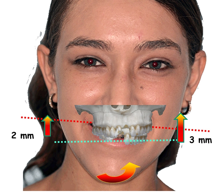 Abb. 14a–g: Chirurgische Planungsschritte.
g: Eine größere Impaktion auf der linken Seite für die Korrektur der Kauebene und des Zahnfleischlächelns Gummy Smile.