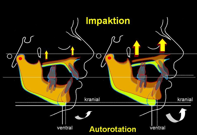 Abb. 19a: Simulation der chirurgischen Impaktion der Maxilla und der folgenden Reaktion der Mandibula im Sinne einer Autorotation nach kranial und gleichzeitig nach ventral, eine stärkere Impaktion führt zu einer stärkeren Autorotation mit den entsprechenden Veränderungen in der Sagittalen und Vertikalen (rechts).