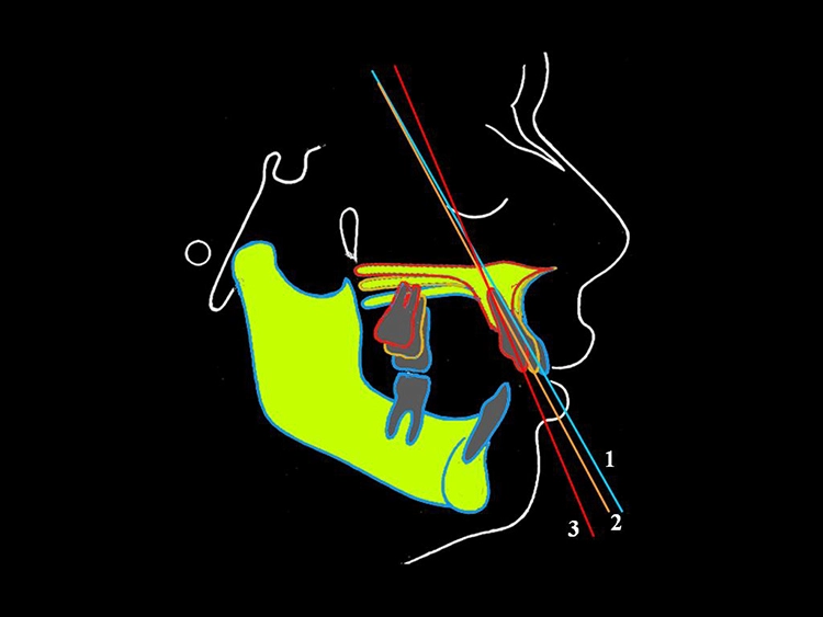 Abb. 19b: Simulation der chirurgischen Impaktion der Maxilla unterschiedlichen Ausmaßes: Je grösser die Impaktion ist, umso steiler werden die Frontzähne sein.