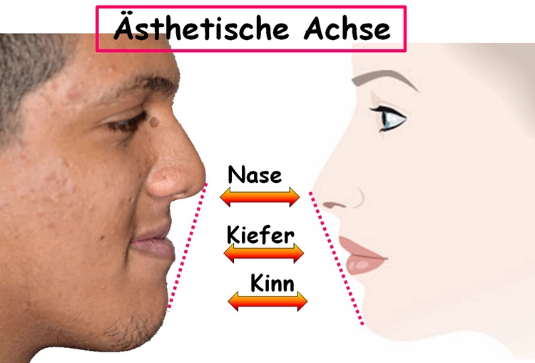 Abb. 2: Einfluss der skelettalen Dysgnathie der Klasse III auf die ästhetische Achse; prognather Unterkiefer bzw. Mittelgesichtshypoplasie.