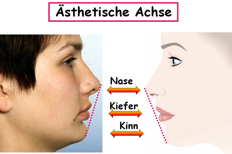 Abb. 3: Einfluss der skelettalen Dysgnathie der Klasse II auf die ästhetische Achse; Rücklage des Unterkiefers.