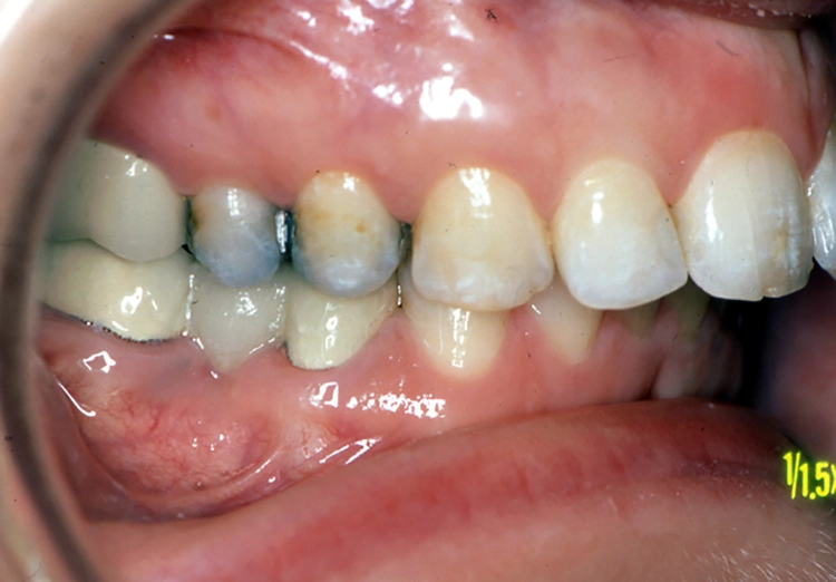 Abb. 6a–c: Harmonisierung des Profils und der ästhetischen Achse nach der Behandlung einer skelettalen Dysgnathie Klasse II. Die skelettale Korrektur wurde durch Unterkieferosteotomie durchgeführt.