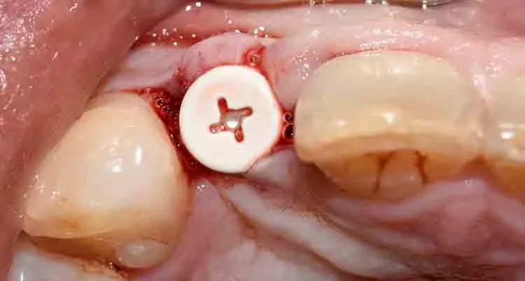 Abb. 3: Standard Zeramex Gingivaformer zur initialen Weichgewebsausformung.