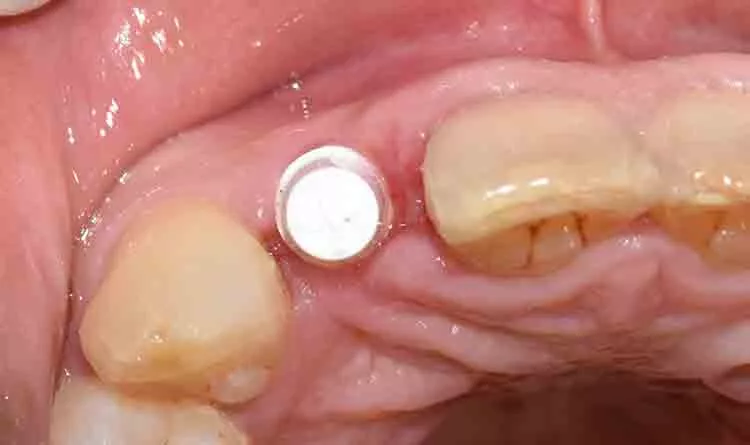 Abb. 6: Zeramex Abutment mit Vicarbo-Schraube fixiert und abgedecktem Schraubenzugang.