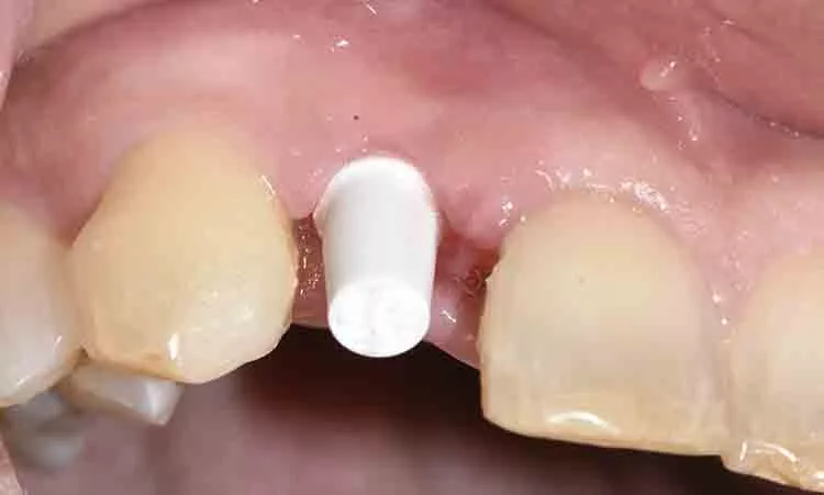 Abb. 7: Zeramex Standard-Abutment mit Vicarbo Schraube im Implantat fixiert.