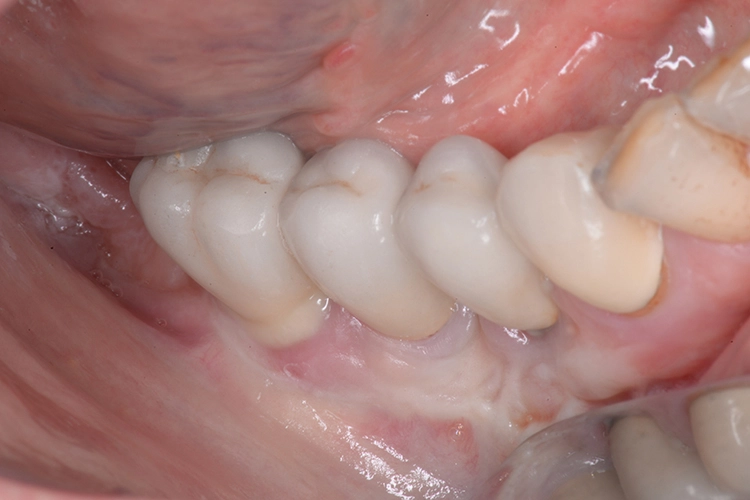 Abb. 1: Klinische Situation vor der Therapie. Sichtbare Suppuration am Implantat regio 46.
